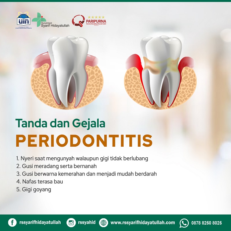 PERIODONTITIS slide 2